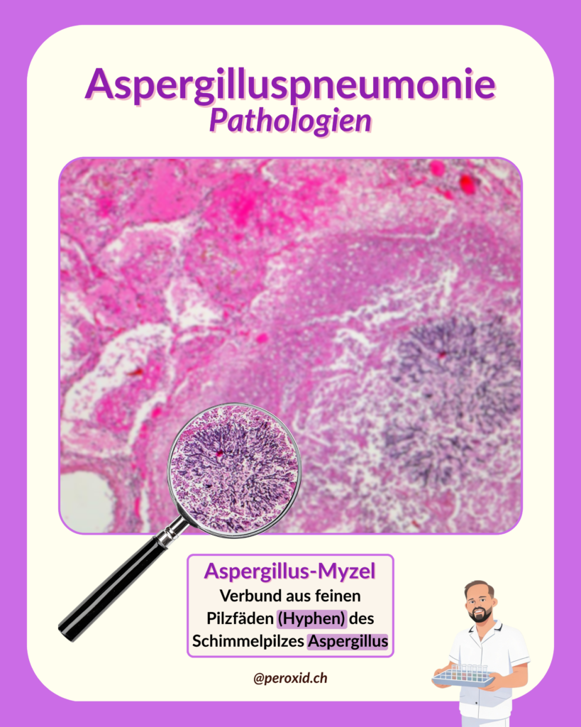 aspergilluspneumonie