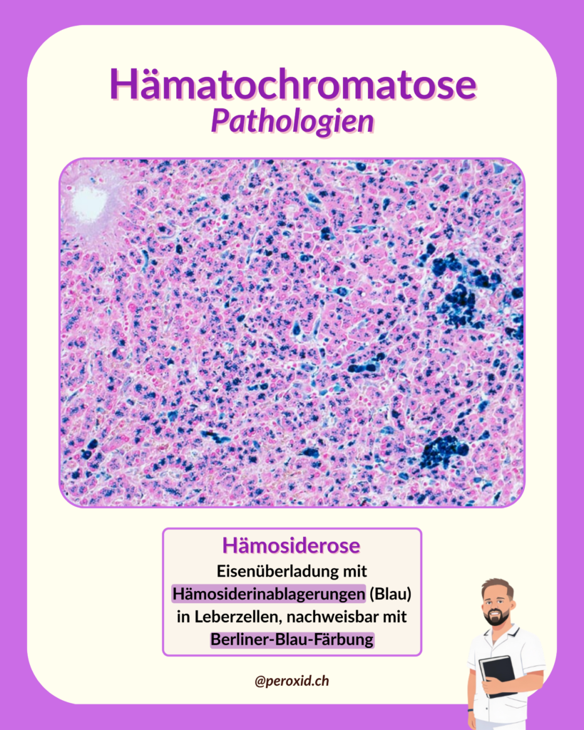 Haematochromatose 819x1024