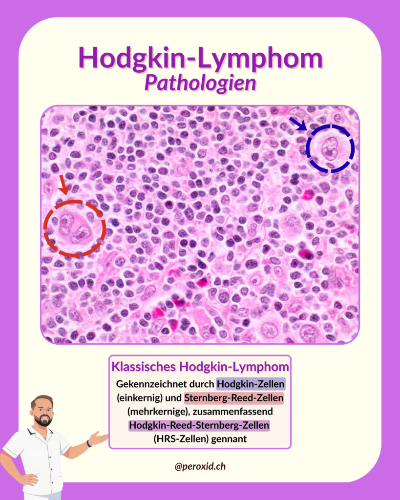 hodgkin lymphom