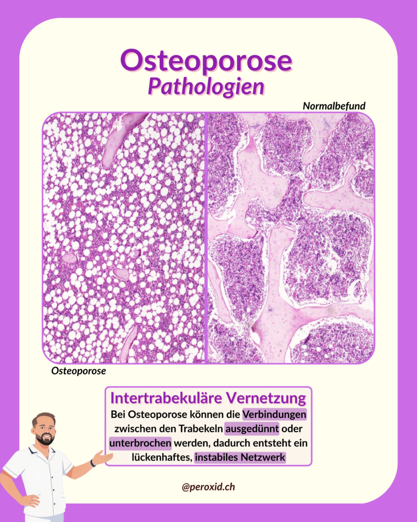 osteoporose