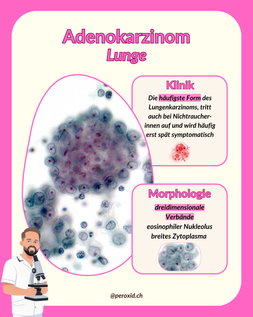 adenokarzinom