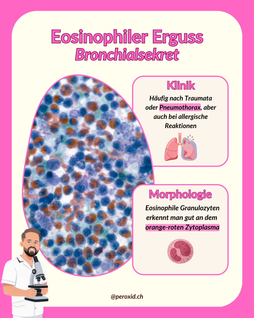 eosinophiler pleuraerguss