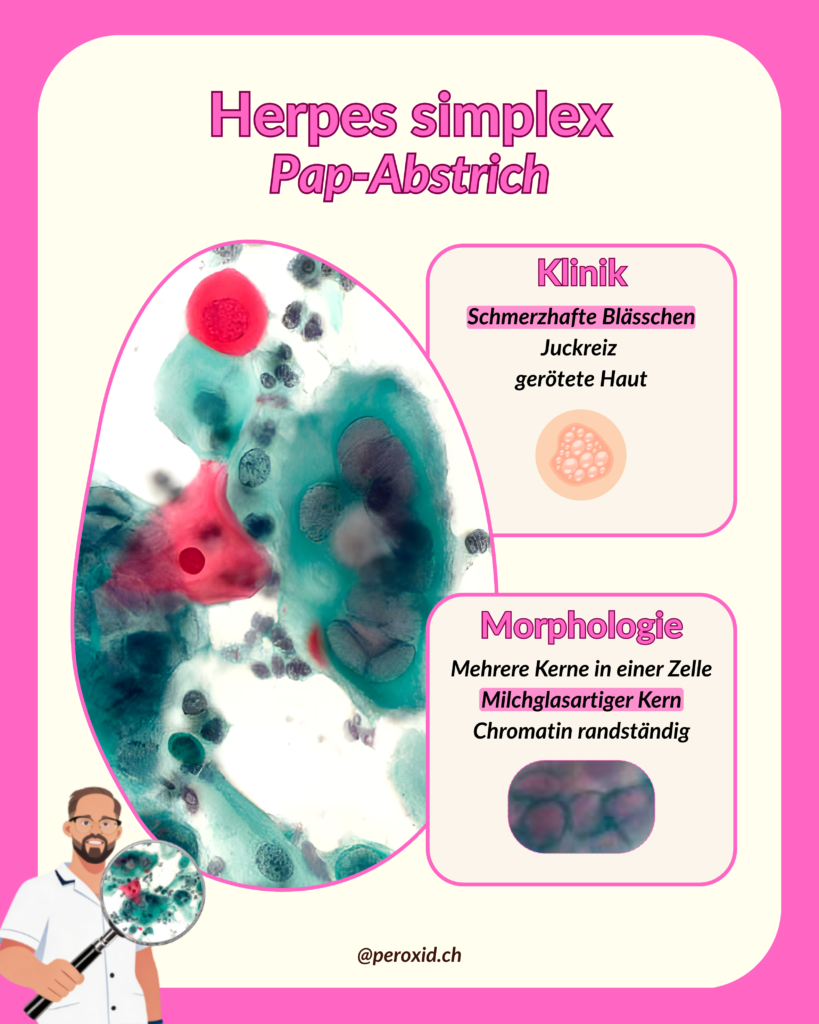 Herpes Simplex 819x1024