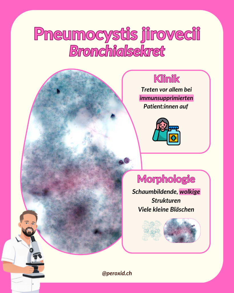 pneumocystis jirovecii